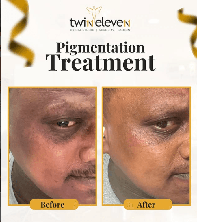 pigmentation